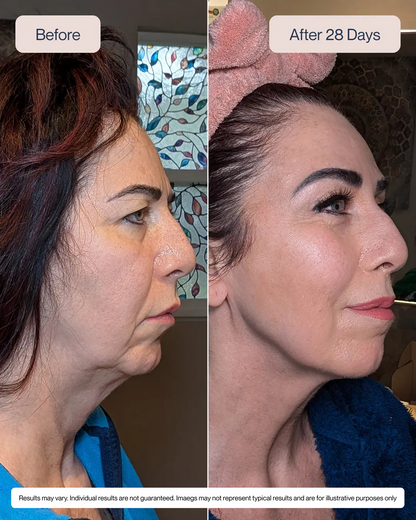 RenewaLift: The Vertical Lip Line Specialist